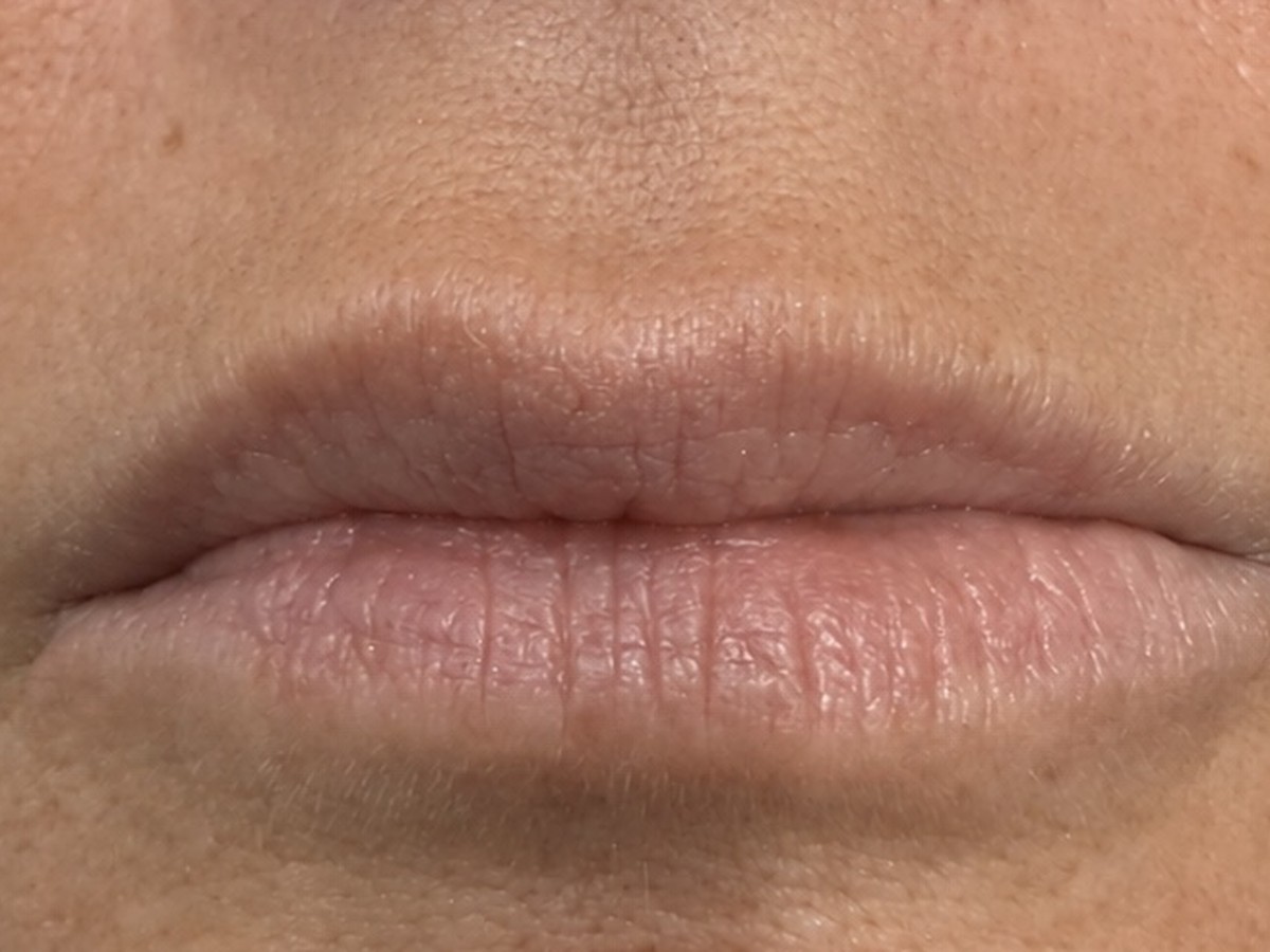 Before lip filler treatment result for Denise
