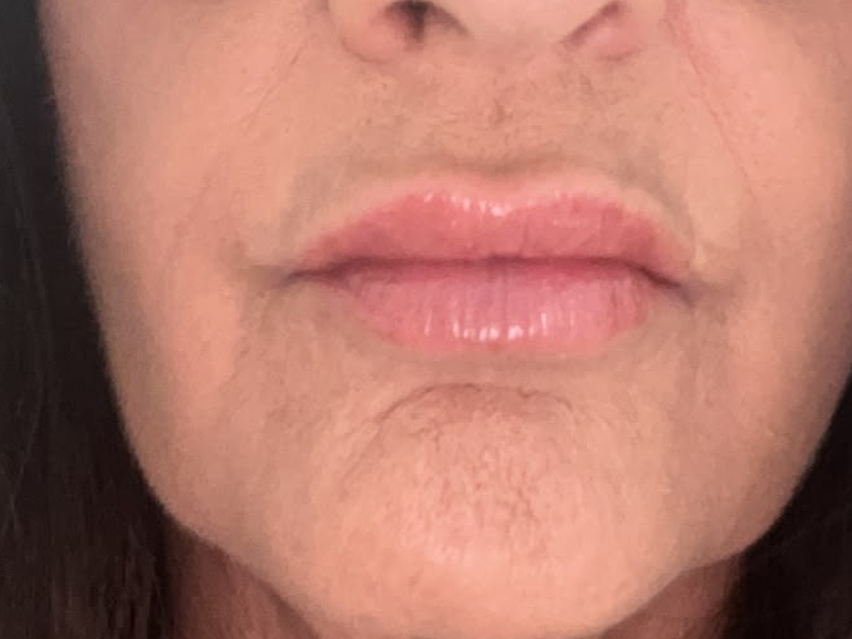 After lip filler treatment result for Denise